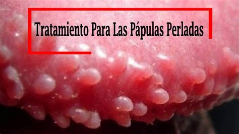 papulas perleadas|Pápulas perladas: qué es, síntomas y tratamiento